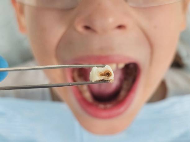 Best Emergency Tooth Extraction in Pecan Plantation, TX